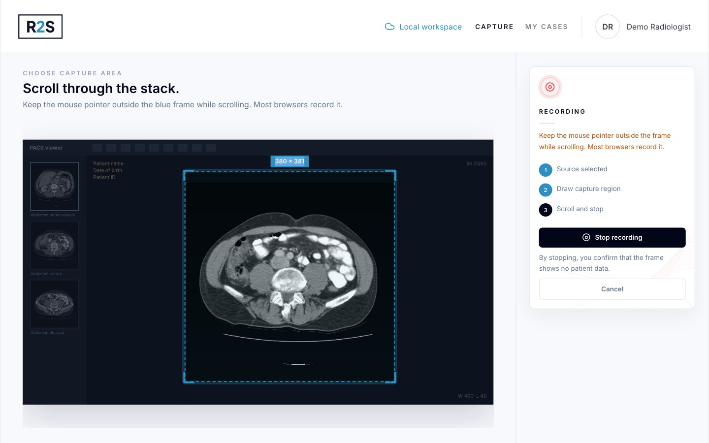 Recording in progress: the blue frame surrounds the CT image and a Stop recording button is shown on the right.